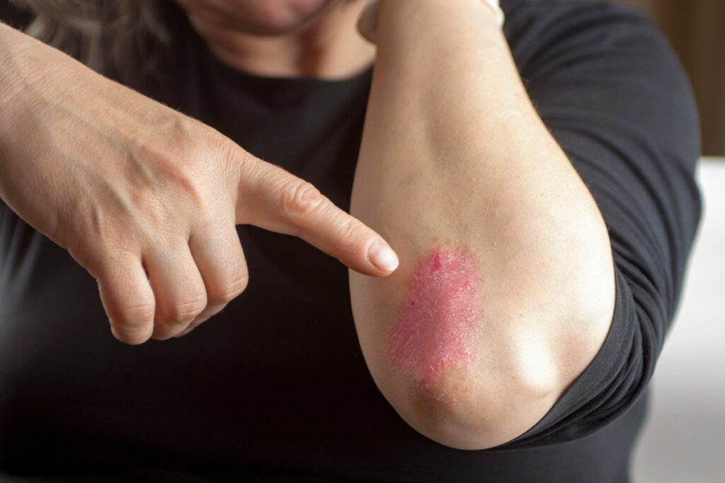 Keto Can Reduce Inflammation psoriasis